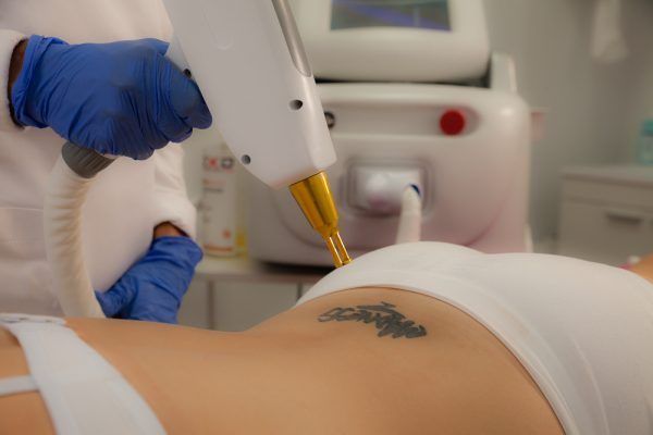 Eliminación de Tatuajes