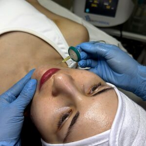 Carboxiterapia Facial