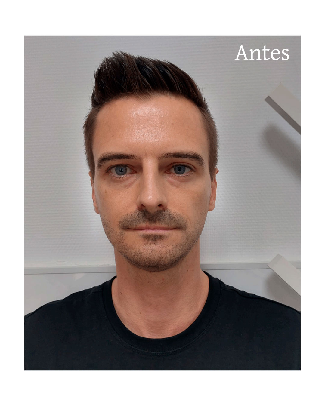 ojeras-2