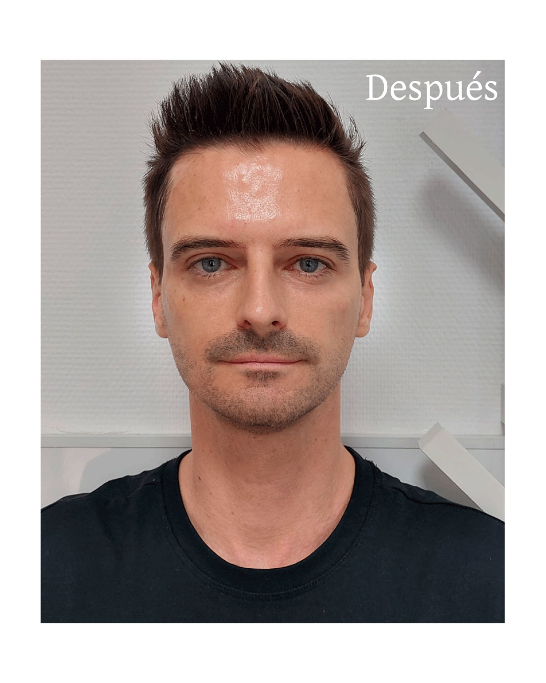 ojeras-3