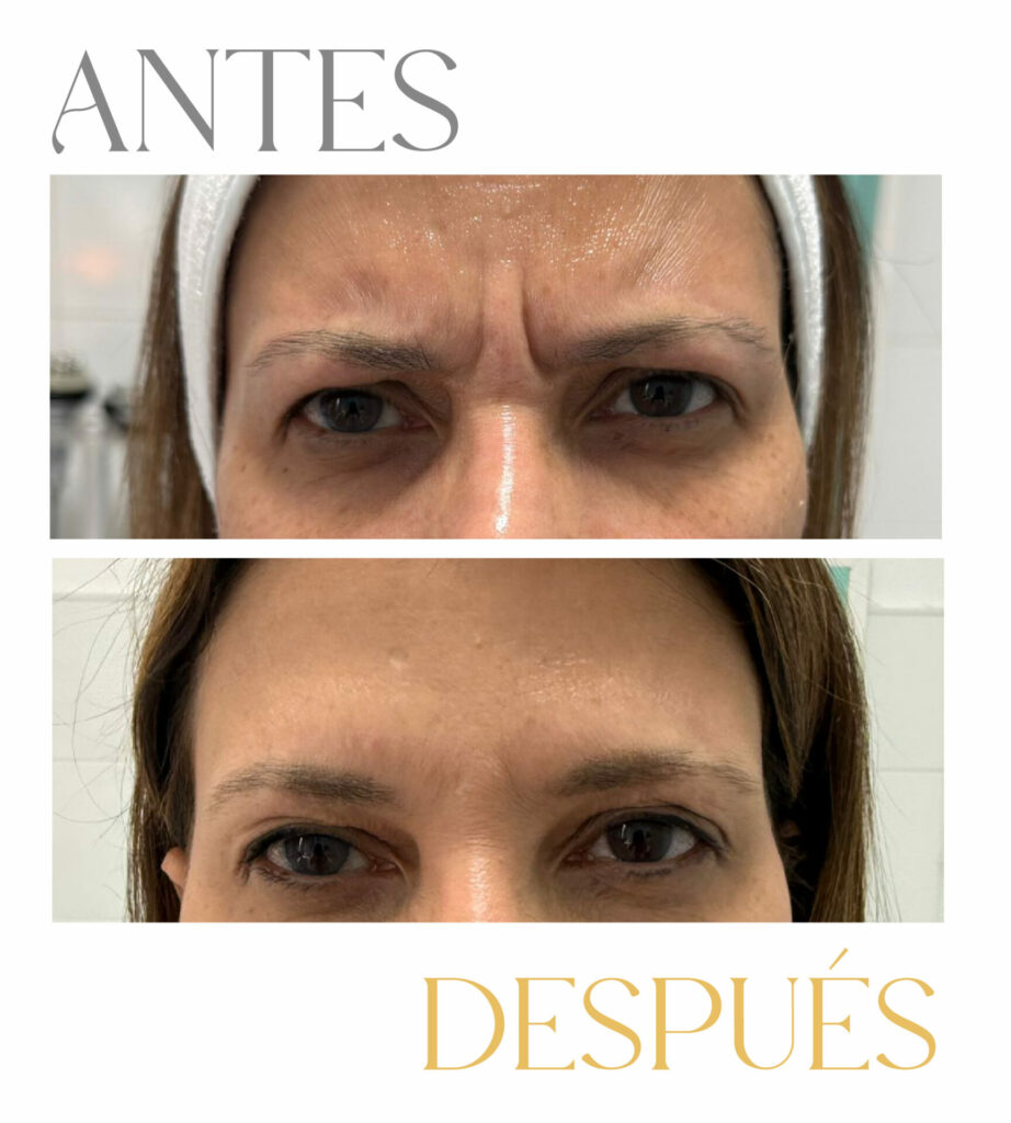 Arrugas del entrecejo antes y después del tratamiento con bótox
