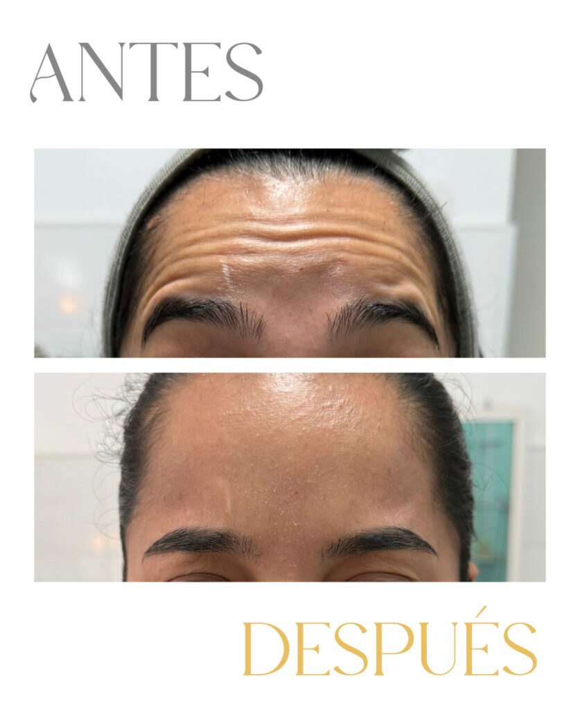Arrugas de la frente antes y después del tratamiento con bótox