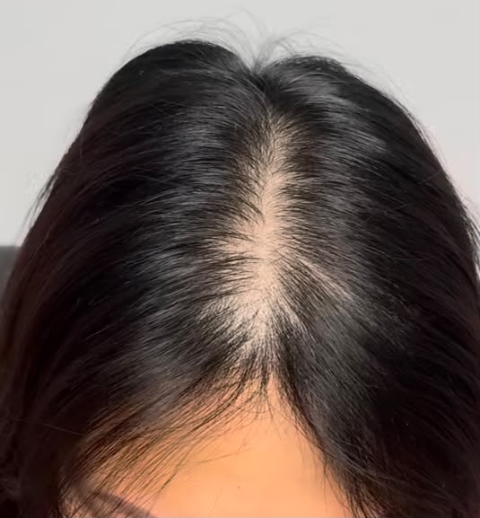 Micropigmentación capilar efecto densidad en mujer, antes