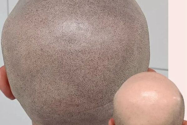 Micropigmentación capilar efecto rapado, antes y después